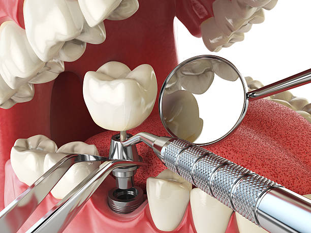 Best Emergency Dental Care for Broken or Chipped Teeth in Mountain Lake, MN